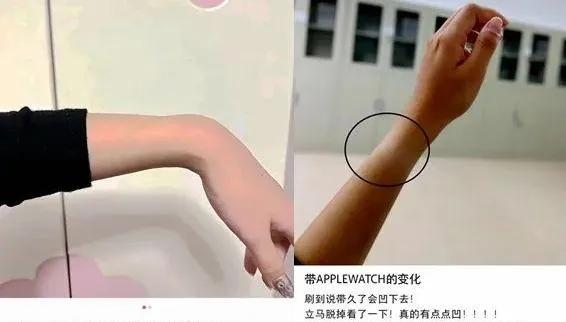 快檢查！戴Apple Watch「手腕凹了」官方回應曝　醫稱出現「這症狀」立刻拿下