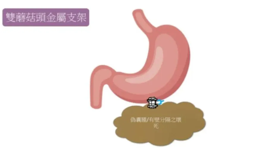 腹痛竟是「急性壞死胰臟炎」！三總「內視鏡清創」2個月成功清完