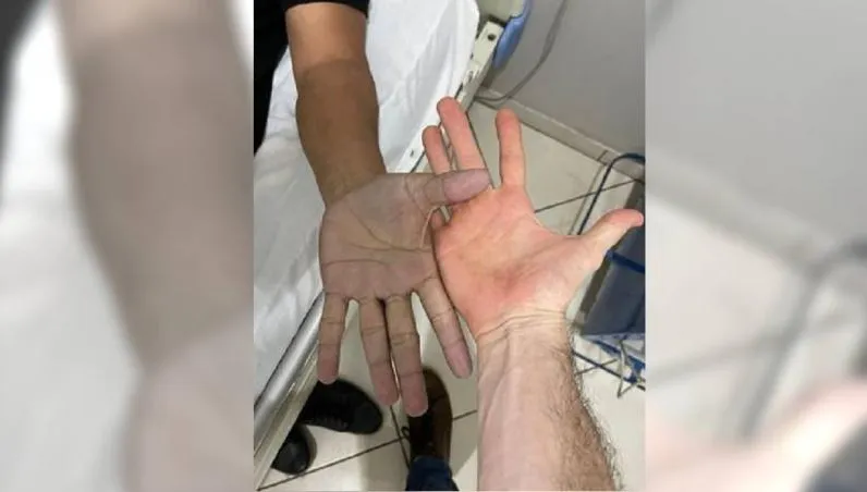 不敢相信！男子雙手突發青緊急就醫　醫詢問後笑翻「你現在就去洗手！」