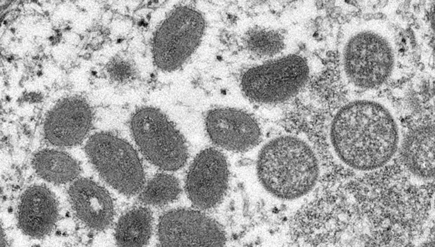 指揮中心：猴痘疫苗增購1萬劑　與確診者性接觸、高風險性行為可接種