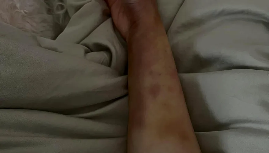 黑一塊青一塊！小謝金燕突曬「恐怖瘀青照」　舒子晨直喊「被往死裡打」
