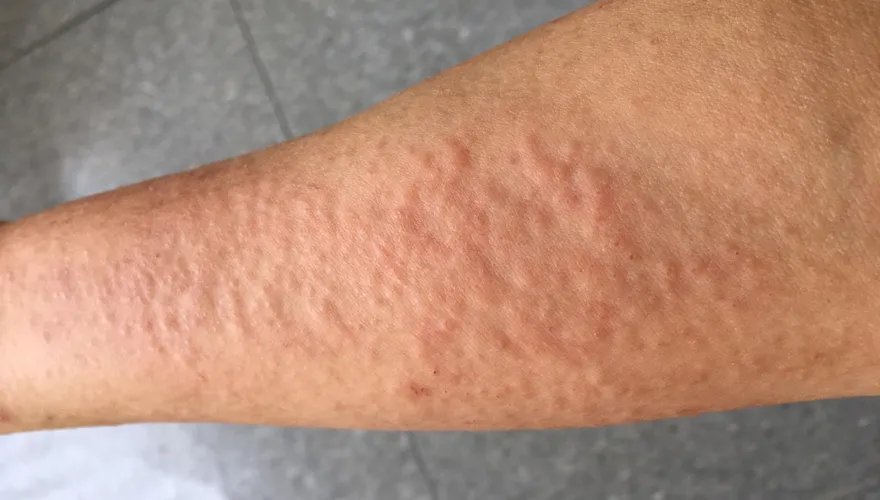 入春後「濕疹」將大爆發！ 花粉、梅雨恐讓病情惡化　專家警告：6件事最傷皮膚