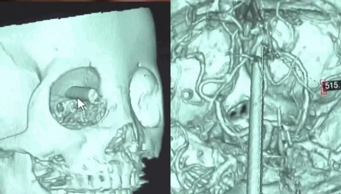 6歲童邊吃邊玩「筷子插眼入腦9cm」奇蹟無大礙