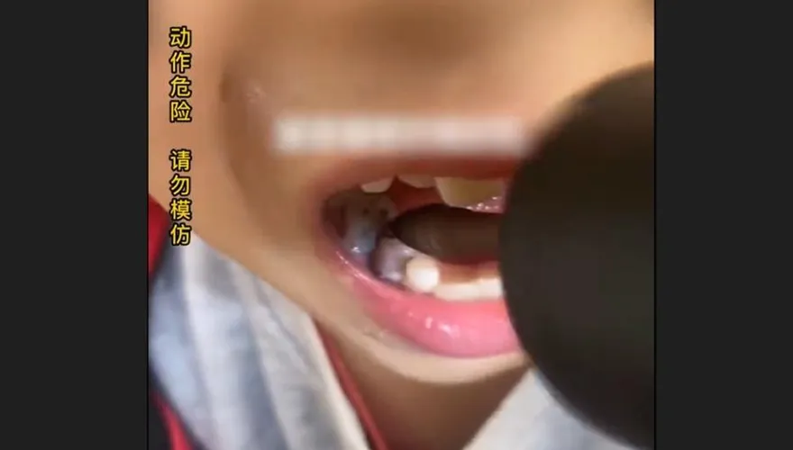 影/兒子唉叫牙痛…超狂老爸拿「家用電鑽」鑽　稱小事「自己也用老虎鉗拔牙」
