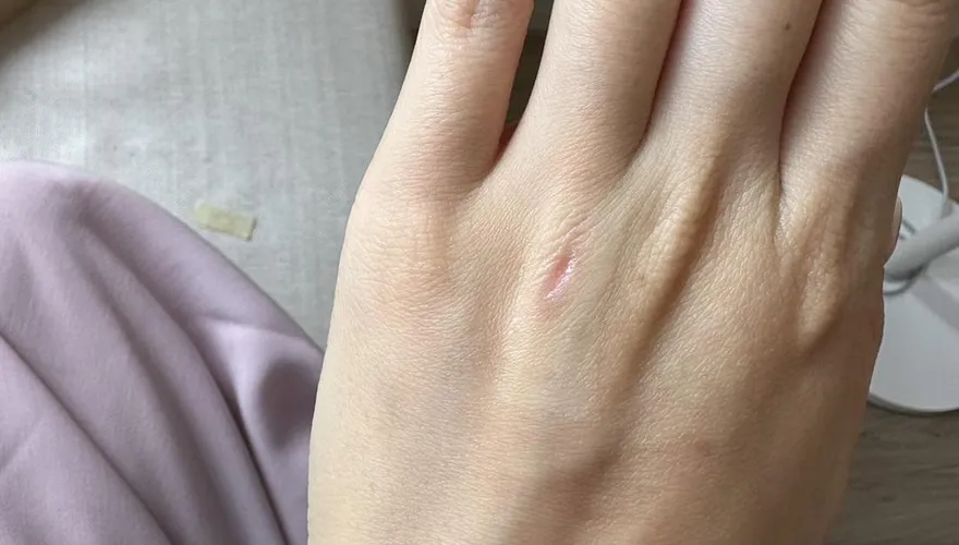 替妹妹除毛…遭削下一塊肉！業者貼OK蹦「再壓人工皮」：只是小破皮　她怒求償被已讀