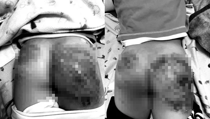 遭跆拳教練持棍毒打！男童屁股「嚴重瘀青」畫面曝　竹市府出手：絕不姑息