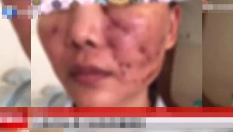 注射1劑「童顏針」滿臉冒膿包！網紅喊煎熬「整整3年不敢外出工作！」