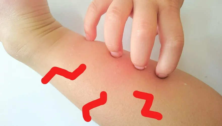 愛吃肉的人容易被蚊子叮？只是迷思！營養師揭3真正原因