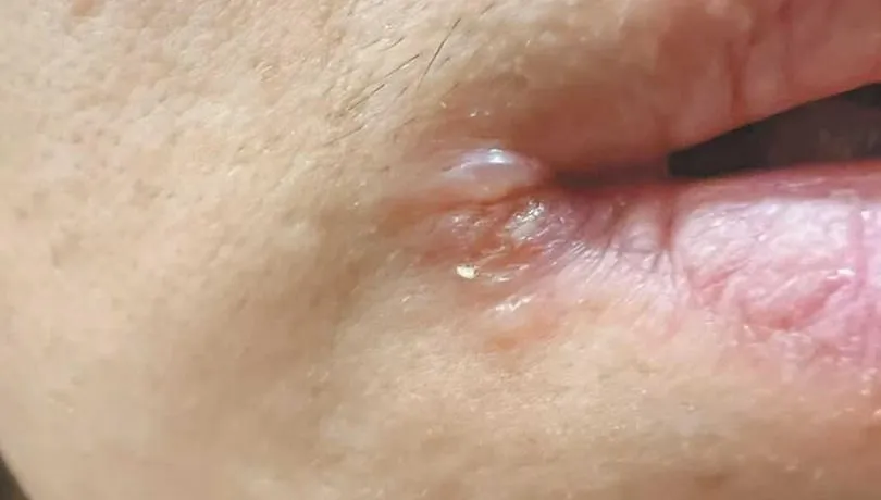 唇皰疹、口角炎難分清！30歲男嘴角紅腫自行買藥擦越腫越大　醫籲：應盡速看診治療