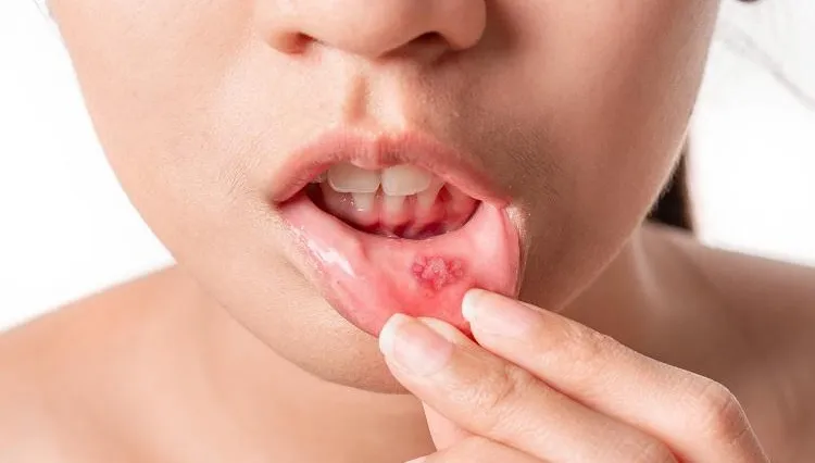 嘴破有特效藥？他痛到求助　一票人激推「奇異果」超有效