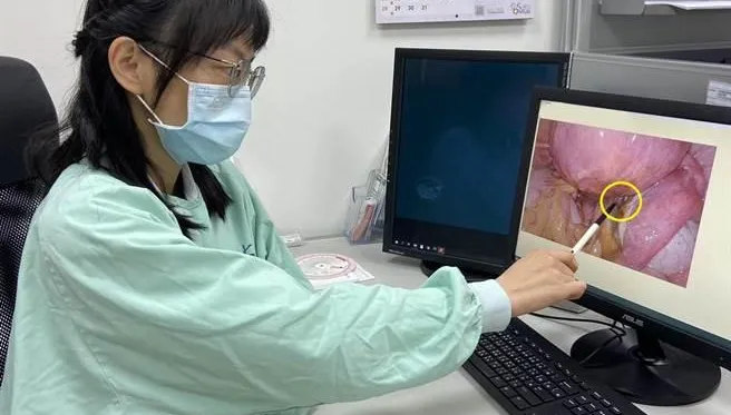 巧克力囊腫可能癌變！「這些人」是高危族群