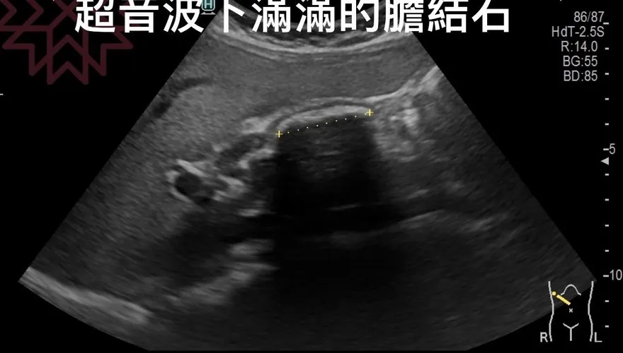 我的天啊！314顆膽結石藏體內　醫籲尿液變色要注意