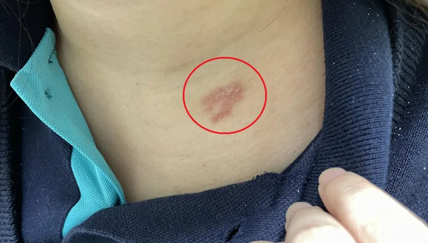 慘上加慘！27歲OL確診長紅疹以為被蚊子叮　醫驚呼：是雙重感染