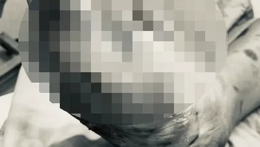 有圖慎入！男拇指發黑竟用利器「整根剪斷」腐肉味飄急診　醫一看超心疼