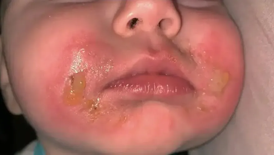 女嬰因啃芹菜　造成「瑪格麗特灼傷」！接觸特定蔬果且受陽光照射小心皮膚炎