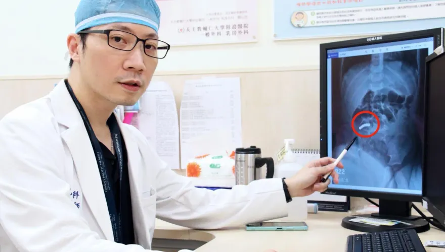 慘！2歲男童誤食「7顆巴克球」　腹痛就醫驚見「腸道穿孔」腸壁缺血壞死