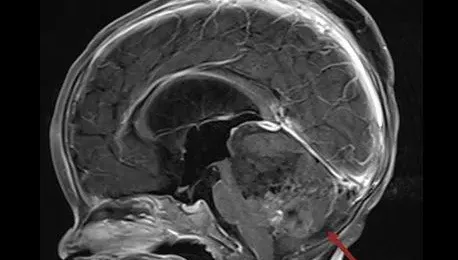 一發病就高致死、易重殘！「流行性腦脊髓膜炎」早打疫苗有效預防