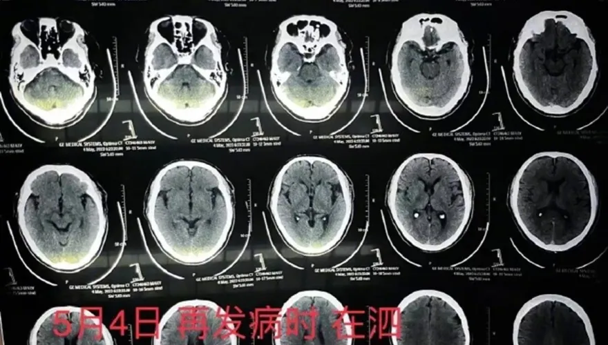 腦中風送醫才知「20萬支架不見了」　醫師認瞞手術失敗：覺得下不了台