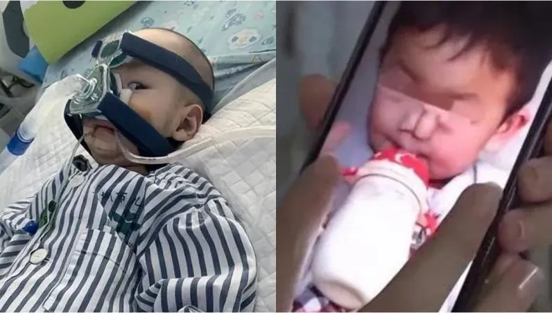 全球僅34例！3歲女童長出罕病「大象鼻」　最嚴重得依賴呼吸器維生