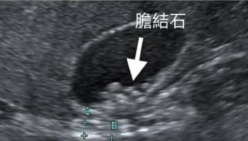 50歲婦女胃脹治不好！竟2年暴長8顆「膽結石」　醫曝「這習慣」釀