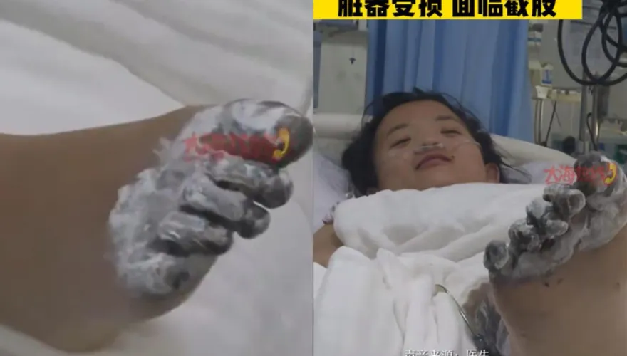 影/邊充電邊玩iPhone…17歲女觸電「腳趾焦黑」需截肢　Apple客服：充電器非原廠不賠