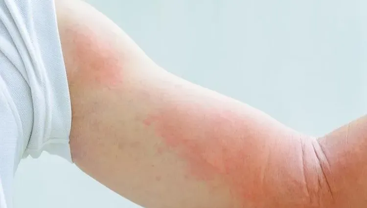 換季就牙起來！蕁麻疹全身癢爆怎辦？ 皮膚科醫認證「7大止癢攻略」