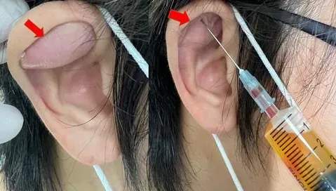 注意！35歲外送員戴安全帽太用力　外耳整個凸出來！醫曝：罕見外耳殼偽囊腫