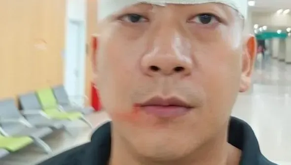 拍張藝謀新戲出意外！李嘉遭燈擊中血流如注「險成獨眼龍」