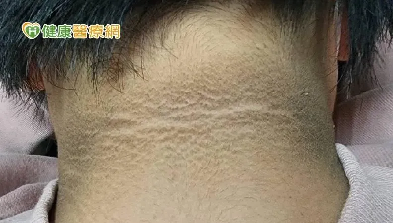 小時候胖要注意！國中生肥胖出現「黑色頸紋」　嚴重恐演變成糖尿病