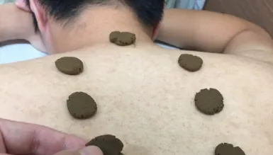 中醫「三伏貼療法」開跑！醫：8月底前是治療最佳時機