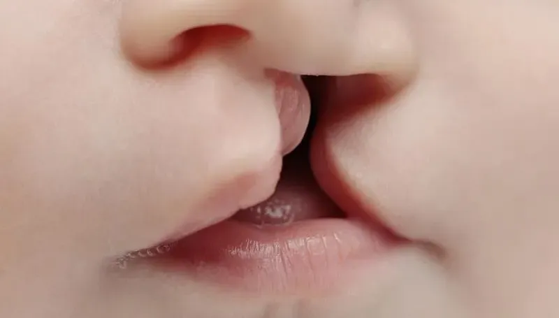 每600個新生兒就有1個唇顎裂！ 先天顱顏缺陷的孩子該被生下嗎？