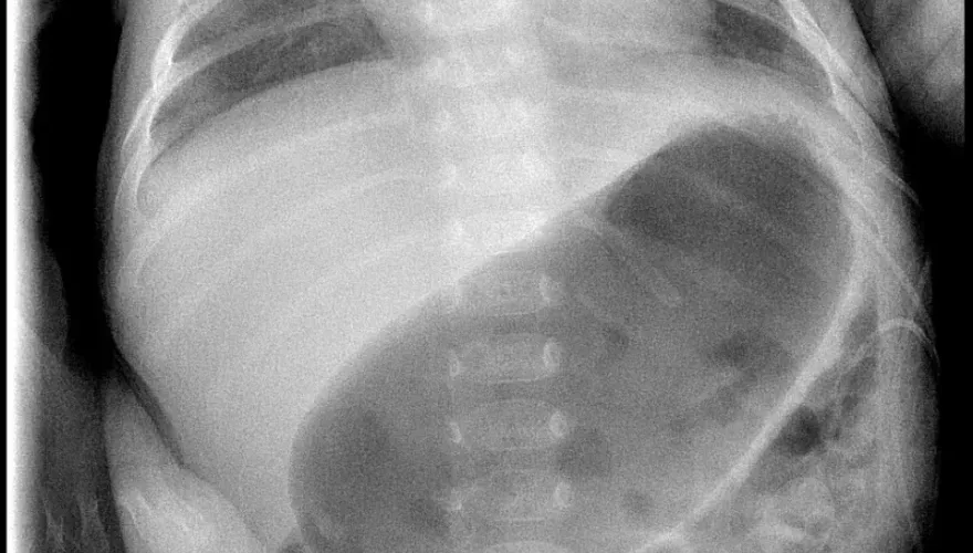 你的孩子常「噴射性」嘔吐？小心是嬰兒肥厚性幽門狹窄