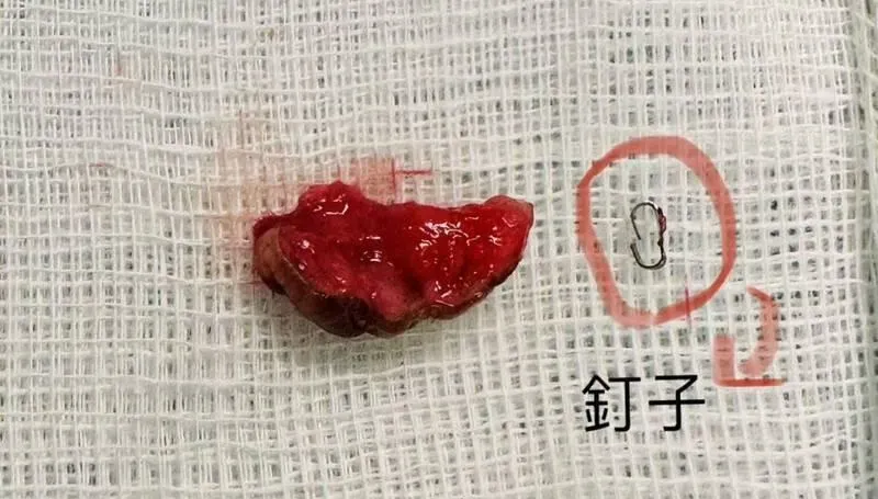 愛愛時小兄弟總是有「腫凸感」？切開一看包皮上竟有「釘子」