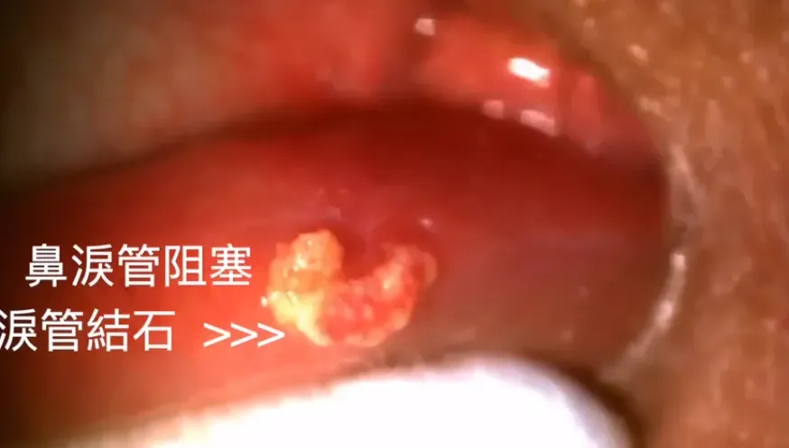 淚眼汪汪不是愛哭！眼有分泌物、紅紅的恐是「淚管結石」
