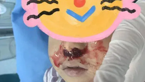 母湯！3歲童流鼻血奶奶往鼻裡塞「頭髮」　血沒止住送醫已休克
