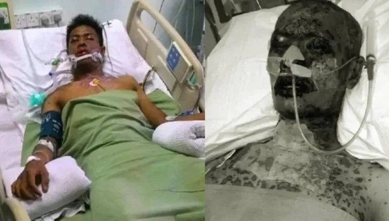 滴眼藥水竟罹罕病　男「全身爆疹」臉爛瀕死…妻喊還有救求幫助