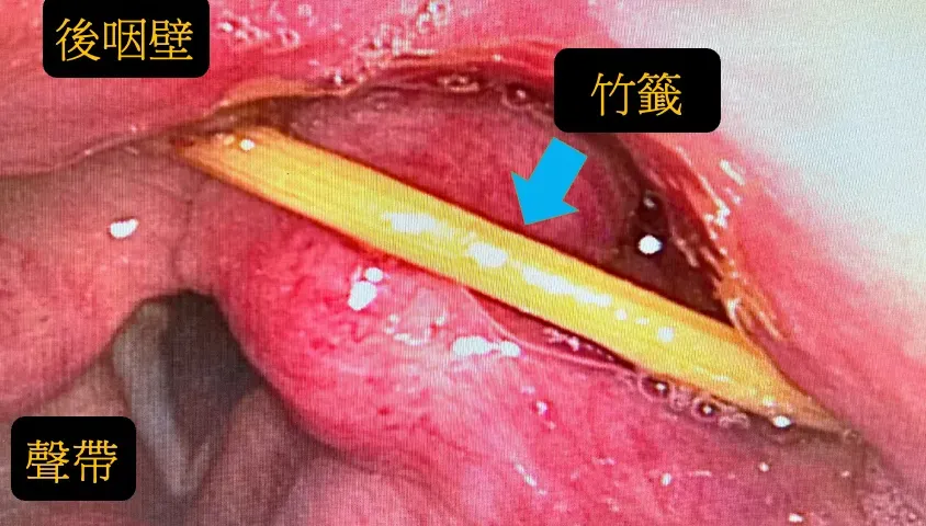 吃肉串吃太急連竹籤都吞了！醫驚呆　嚴重會大出血導致窒息