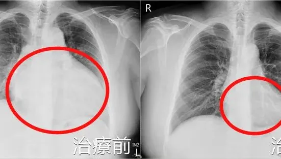 45歲男「爬1層樓就喘」心臟竟超大如籃球！嚴重恐猝死