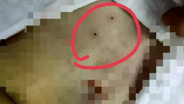 4歲女童命喪手術台！做骨髓穿刺卻碰上醫療疏失　醫生失手「連刺兩針進心臟」