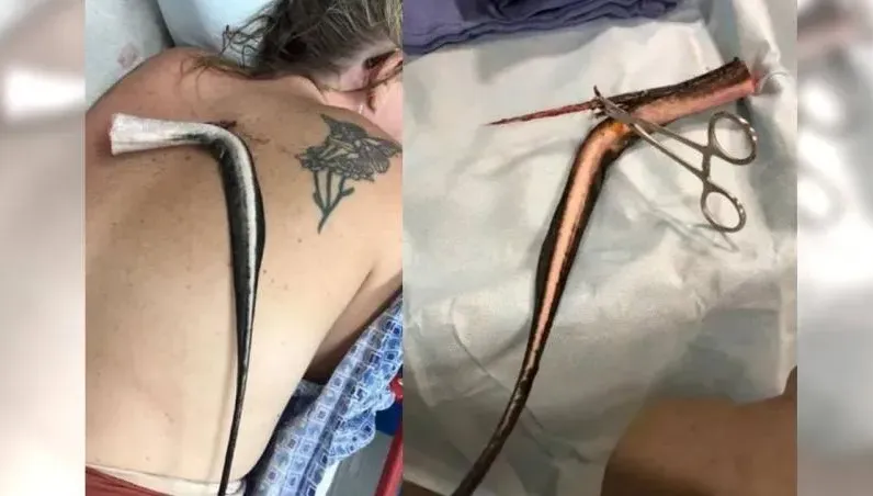 海灘玩水魟魚毒刺竟扎進身體！　美國女爆痛直呼：「我要死了」