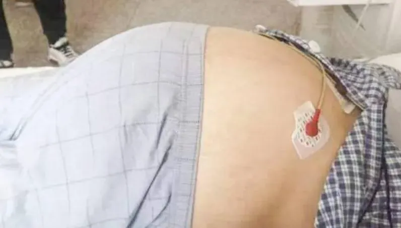 39歲女肚藏16KG超大腫瘤！腸子被壓成「紙片」　醫：比癌還惡