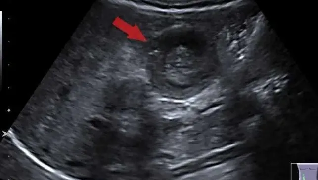 嬰幼兒染「腺病毒」後哭鬧不安！醫示警：「腸套疊」嚴重恐腹膜炎