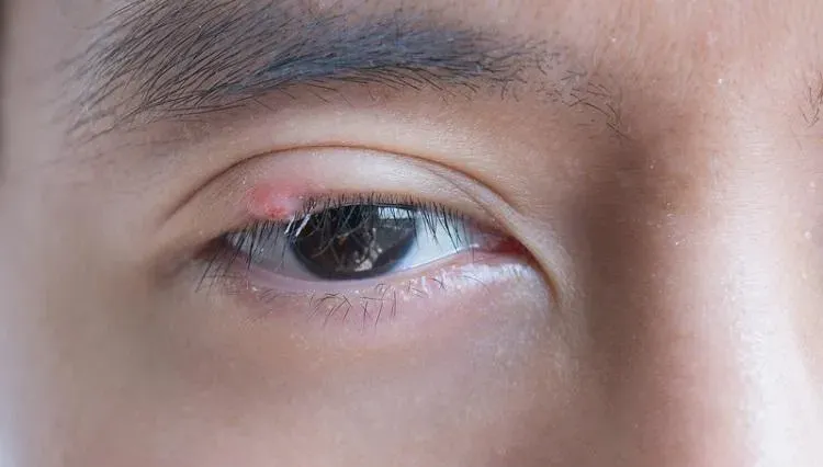 不是針眼！他眼瞼長小顆粒...經切片後才知罹罕見「皮脂腺癌」　醫示警了
