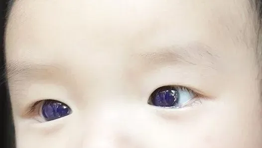 服「法匹拉韋」治新冠！一夜之間泰國男嬰變「藍眼睛」