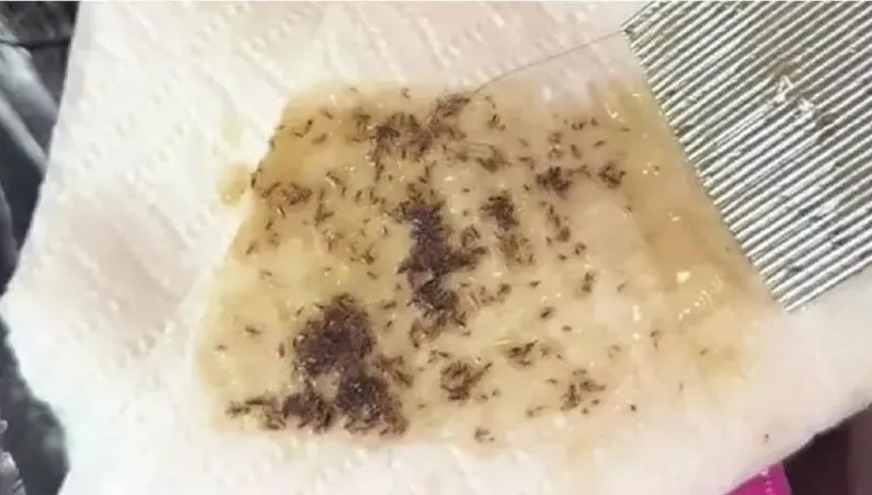 慎入！女頭髮多年住數千隻蝨子「在頭皮上爬行」　網：應該不只有我頭開始在癢吧