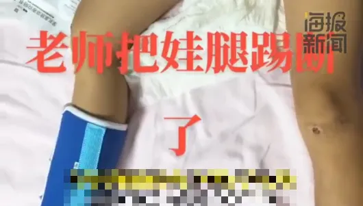 誇張！武術老師踢斷學生腿沒通知家長　偷送醫還「假扮親戚」簽診斷書