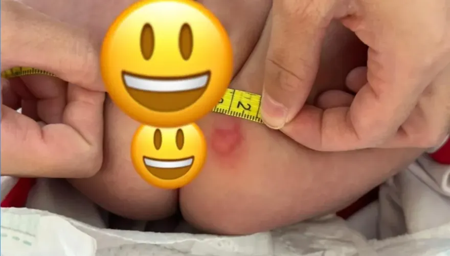 好心疼！女嬰住院屁股磨破皮流血　院方：不習慣「尿布」引起尿布疹