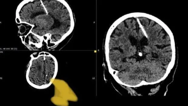 70歲老婦腦袋裡有根針竟然還活跳跳　衛生部門：可能為二戰時期殺嬰潮受害者