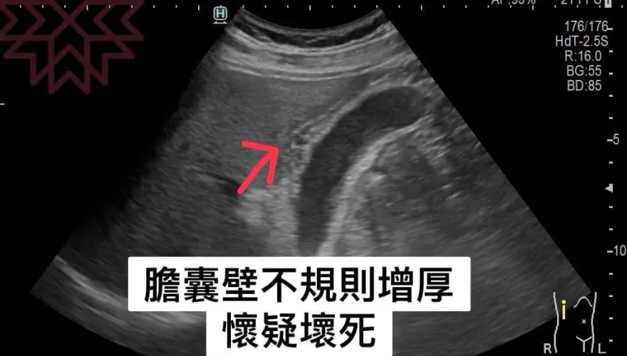 有圖慎入！壯男的膽「腫如士林大香腸」　醫照驚呼：不得了了