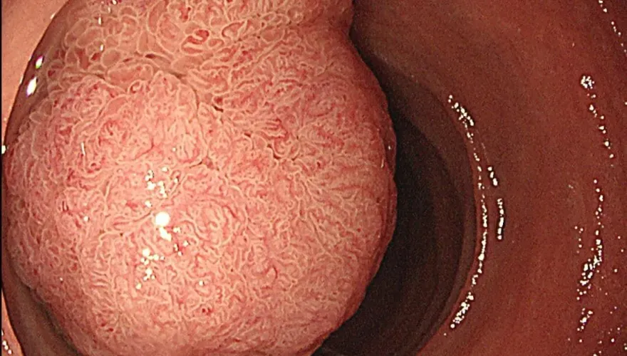 60女胃痛就醫　內視鏡檢查竟見「5公分的壺腹腫瘤」堵住十二指腸二分之一！